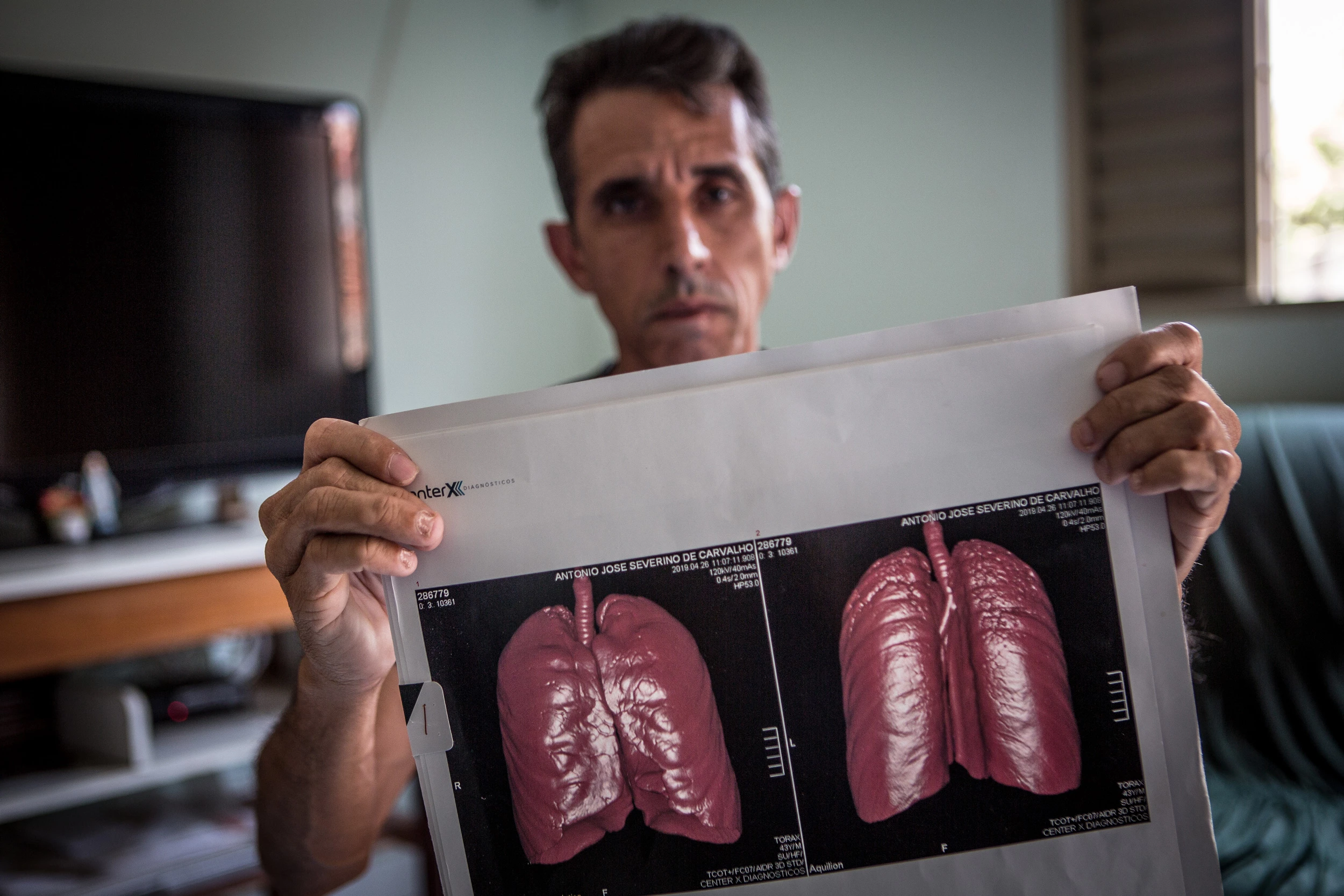 Antonio José Severino de Carvalho, de 44 anos, ex funcionário da mineradora Sama, mostra seus exames mostrando resultados da abestose em seus pulmões. Antonio trabalhou na Sama por 11 anos e 8 meses.