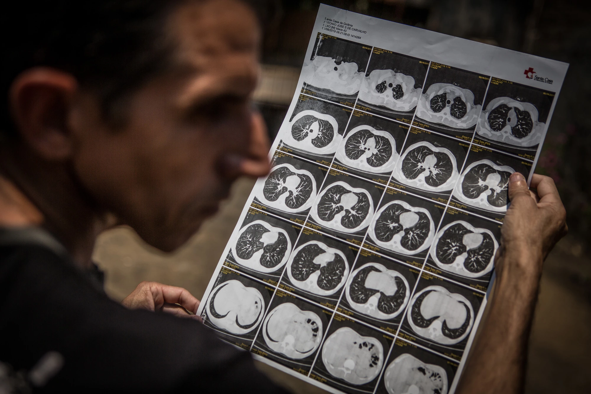 Antonio José Severino de Carvalho, de 44 anos, ex-funcionário da mineradora Sama, mostra seus exames mostrando resultados da abestose em seus pulmões.