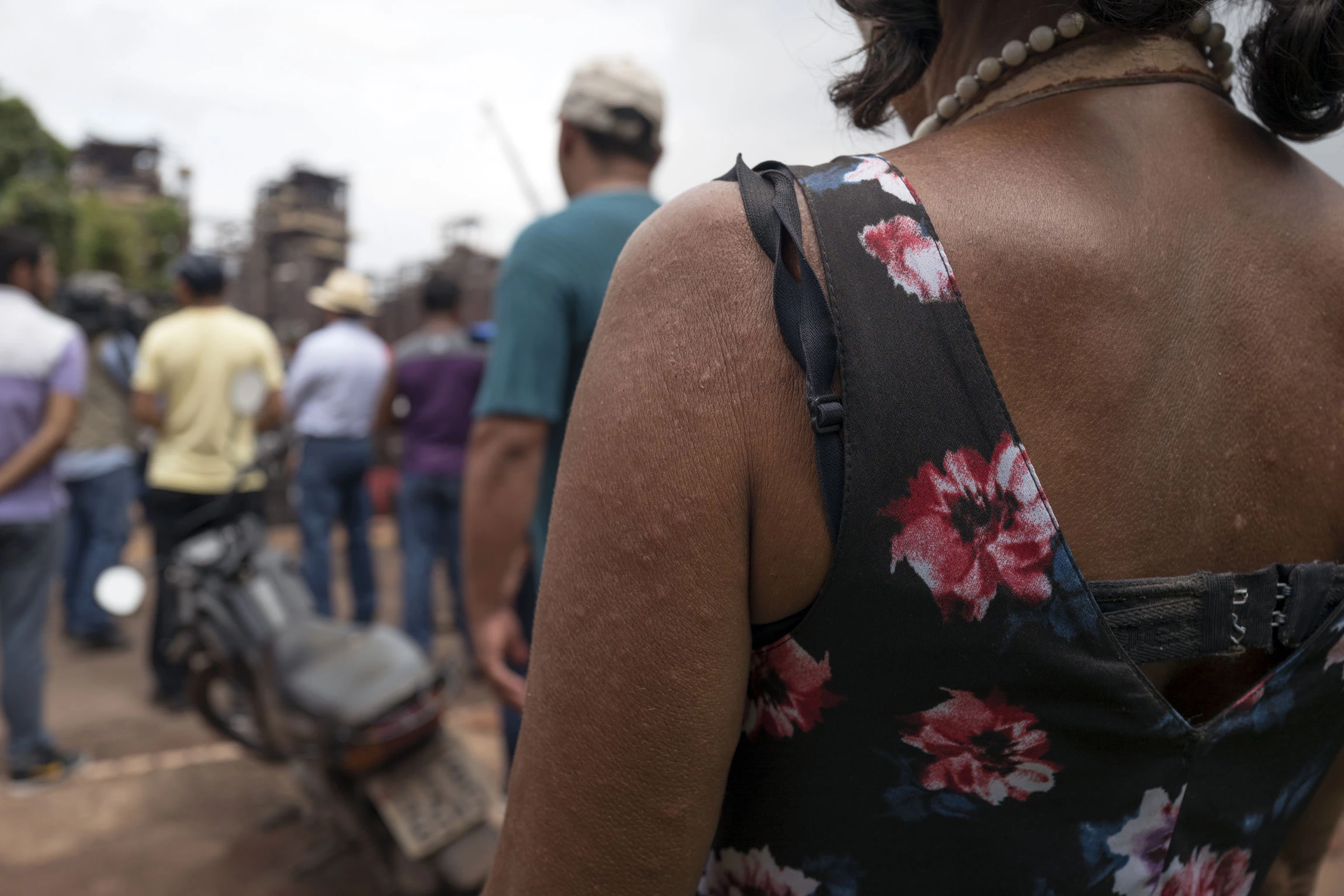 A demonstrator, with a rash on her body allegedly caused from contaminated water, stands during a protest against Norsk Hydro ASA discharging untreated water into a nearby river in front of the company's alumina refinery in Barcarena, Para state, Brazil, on Wednesday, Feb. 28, 2018. A Brazilian judge ordered Norsk Hydro ASA to pay for residents to be tested for health problems related to possible contamination caused by leakage from the company's Amazonian alumina operations, court documents show. Photographer: Alessandro Falco/Bloomberg via Getty Images