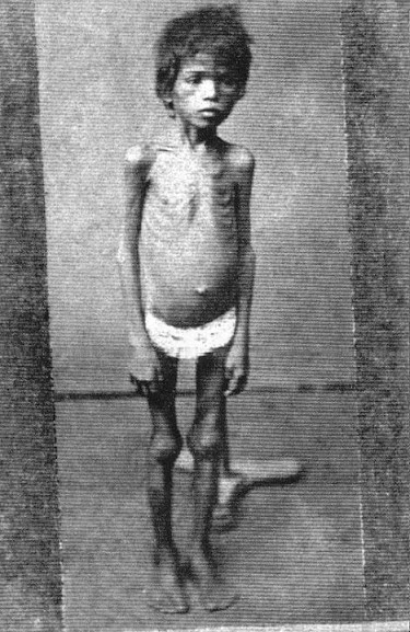 Imagem de uma criança faminta na seca de 1877.