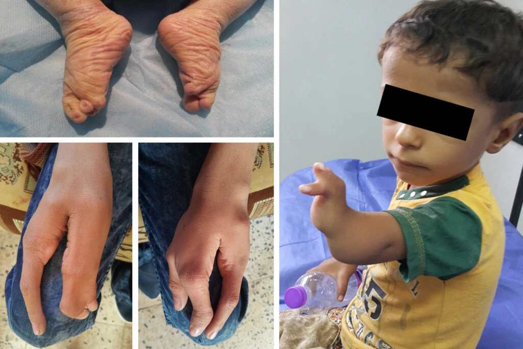 Uma série de imagens de um estudo conduzido por uma equipe independente de médicos pesquisadores mostra as deformidades sofridas pelas crianças pequenas que vivem nas proximidades de uma base militar norte-americana ativa no Iraque.