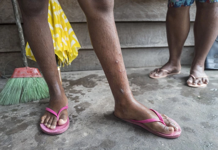 Doenças, sequelas e morte: como gigante do alumínio foi parar na justiça holandesa por contaminação no Pará